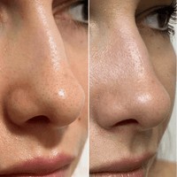 SALICYLIC ACID EXFOLIANT